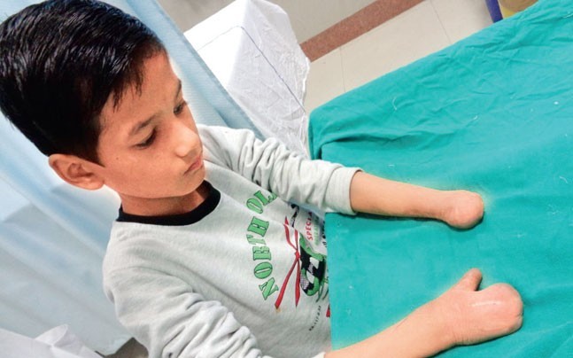 Safdarjung Hospital Doctors Perform ‘Toe-To-Hand’ Surgery On 10-Year-Old Boy