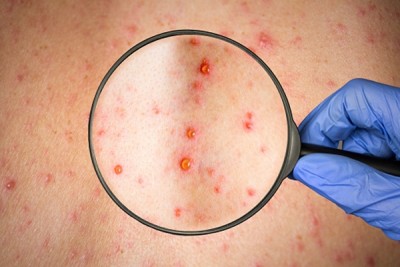 Chickenpox spreading rapidly in Gaya