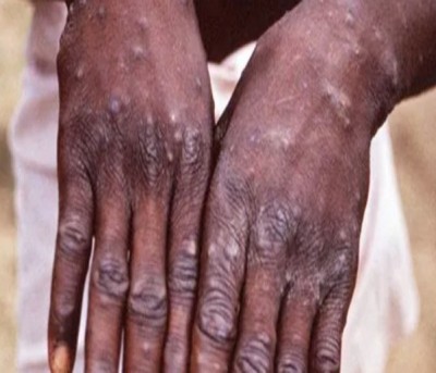 Canada confirms 58 cases of monkeypox