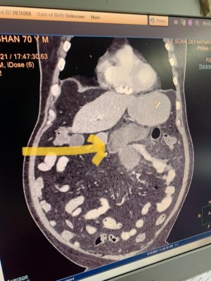 Black fungus of intestine: Novel complication diagnosed in Covid patients in Delhi